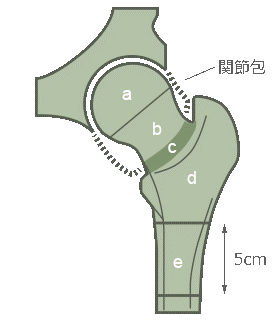 大腿骨付近部骨折の分類画像