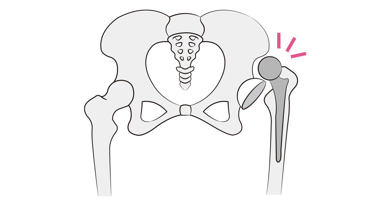 人工股関節置換術後の膝と鼠径部の痛み