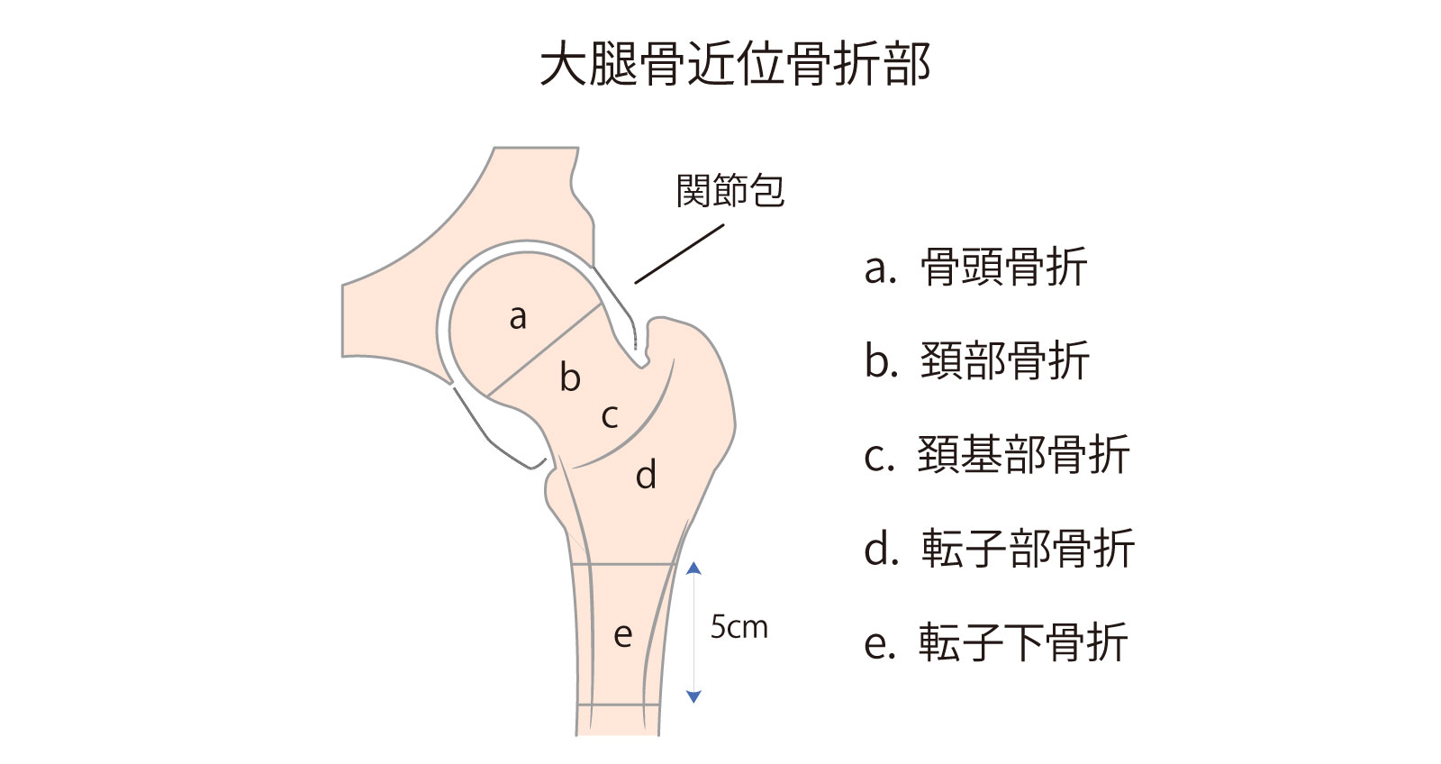 大腿骨近位部骨折のイメージ