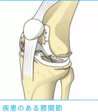 疾患のある膝関節