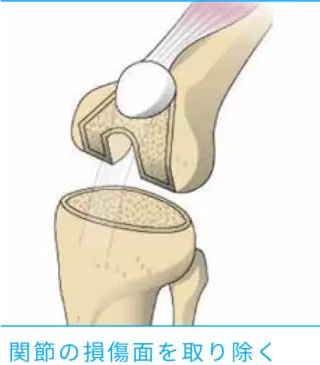 関節の損傷面を取り除く