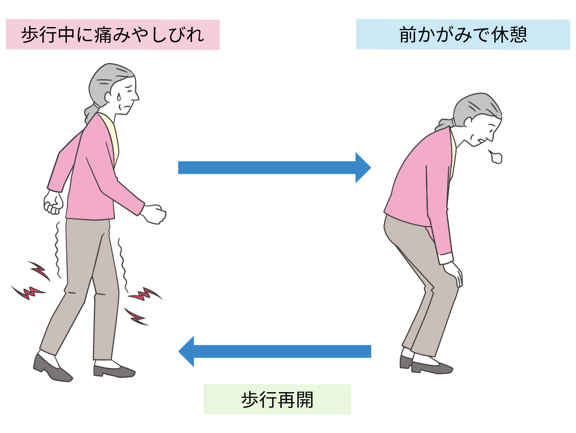 歩行障害のイラスト
