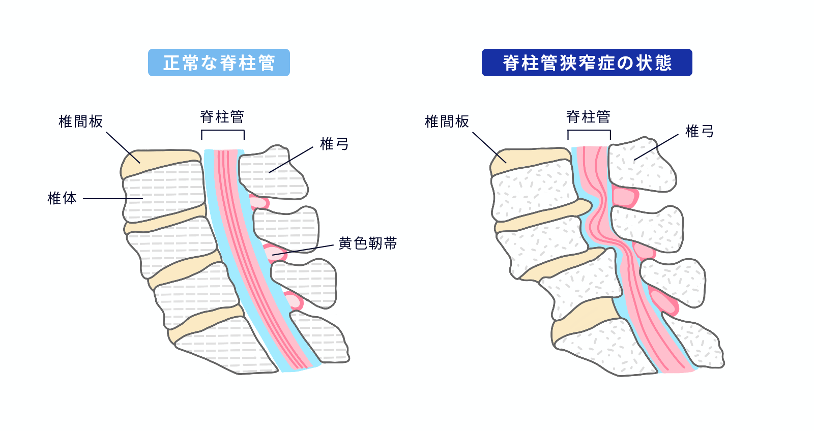 腰部脊柱管狭窄症のイラスト