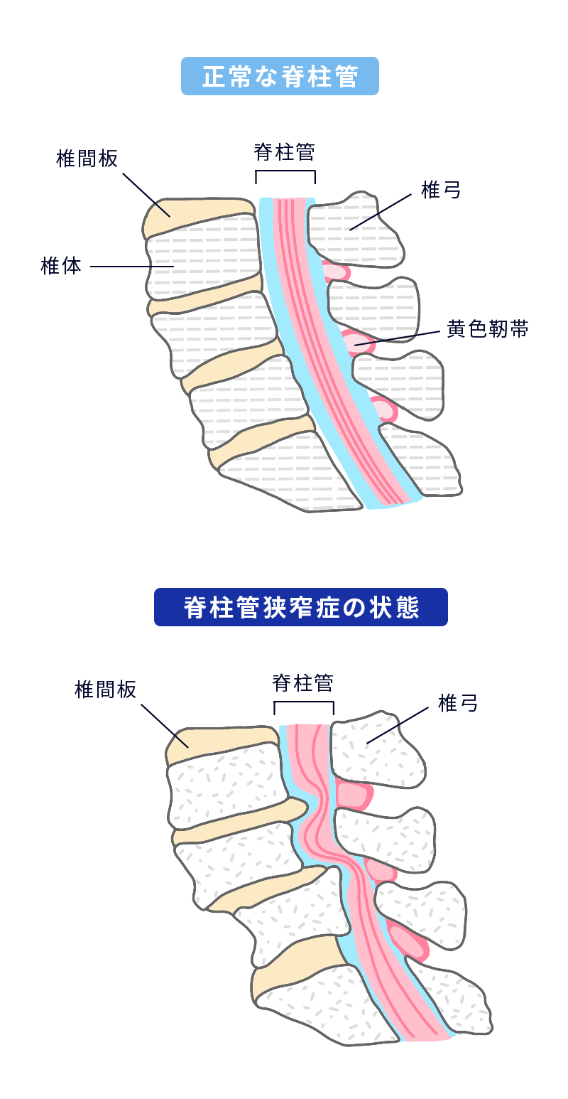 腰部脊柱管狭窄症のイラスト