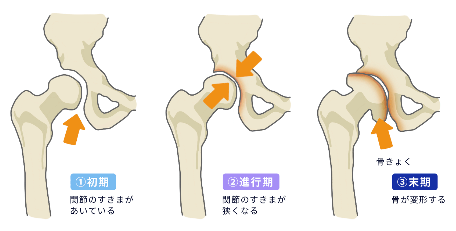 変形性股関節症の症状