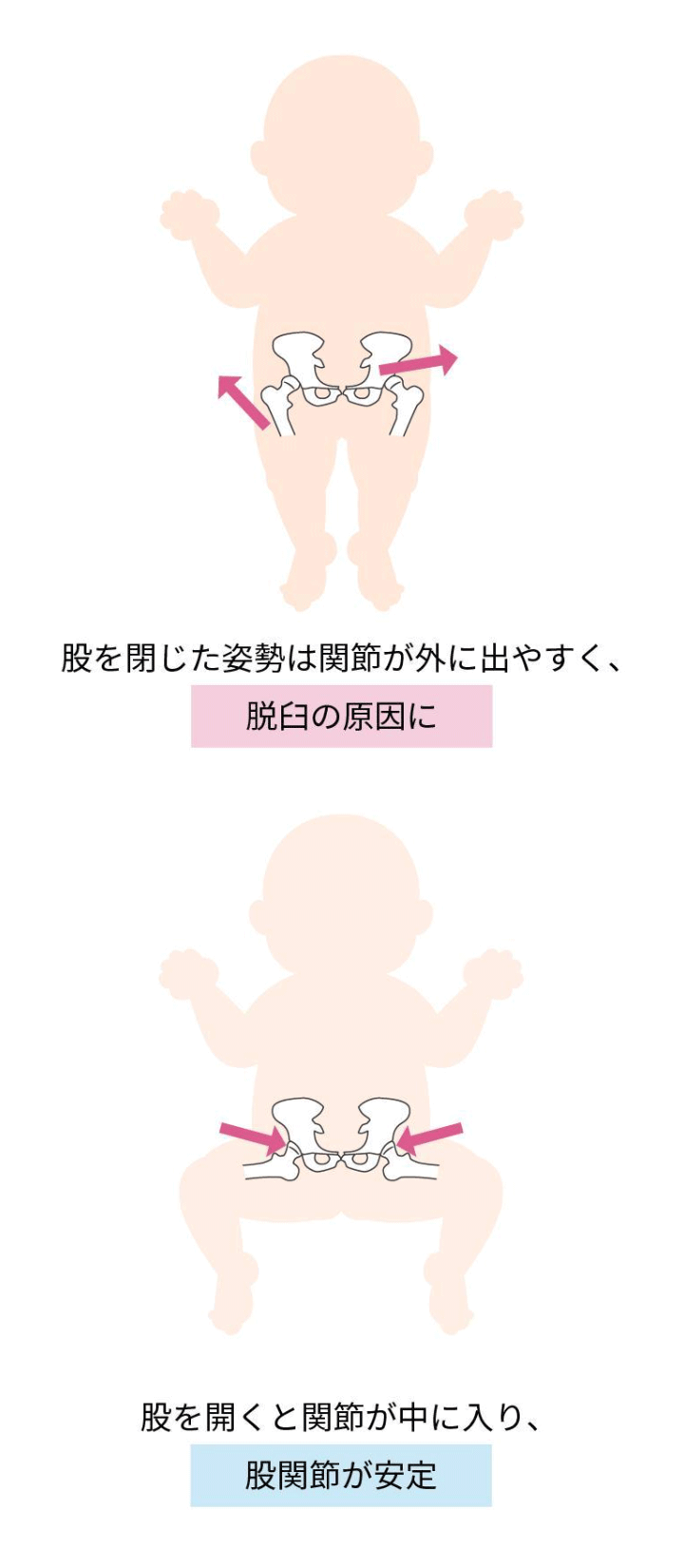 変形性股関節症の原因