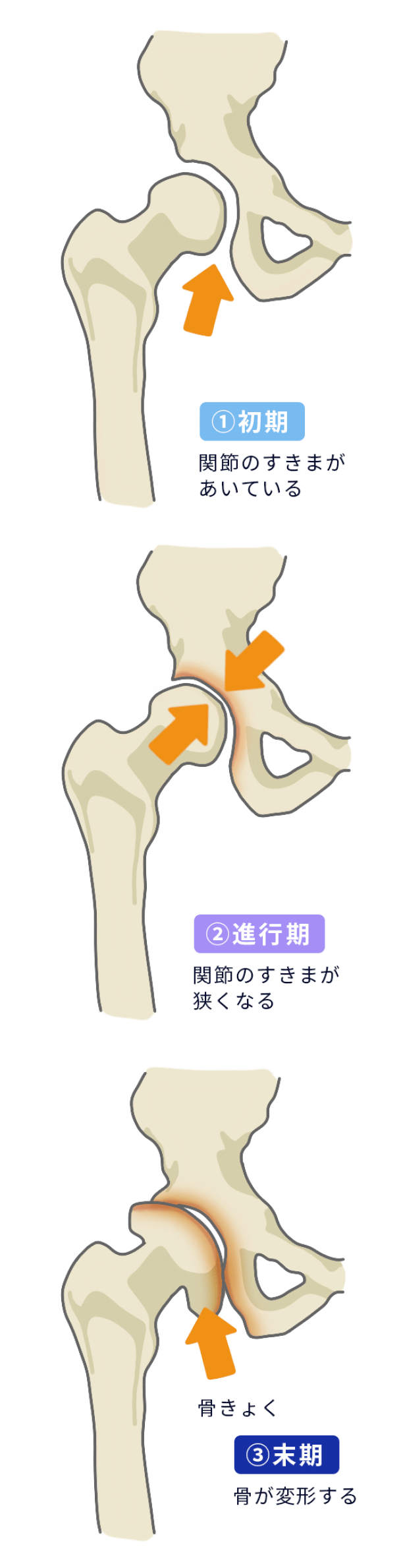 変形性股関節症の症状