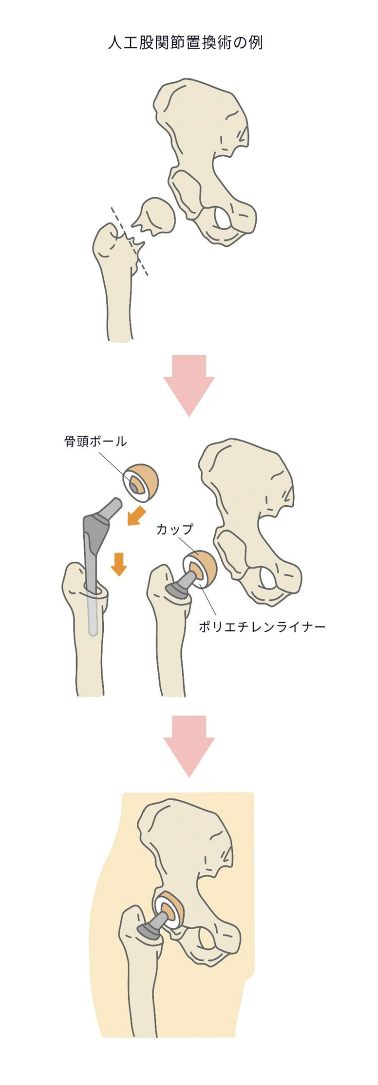 人工股関節置換術の例