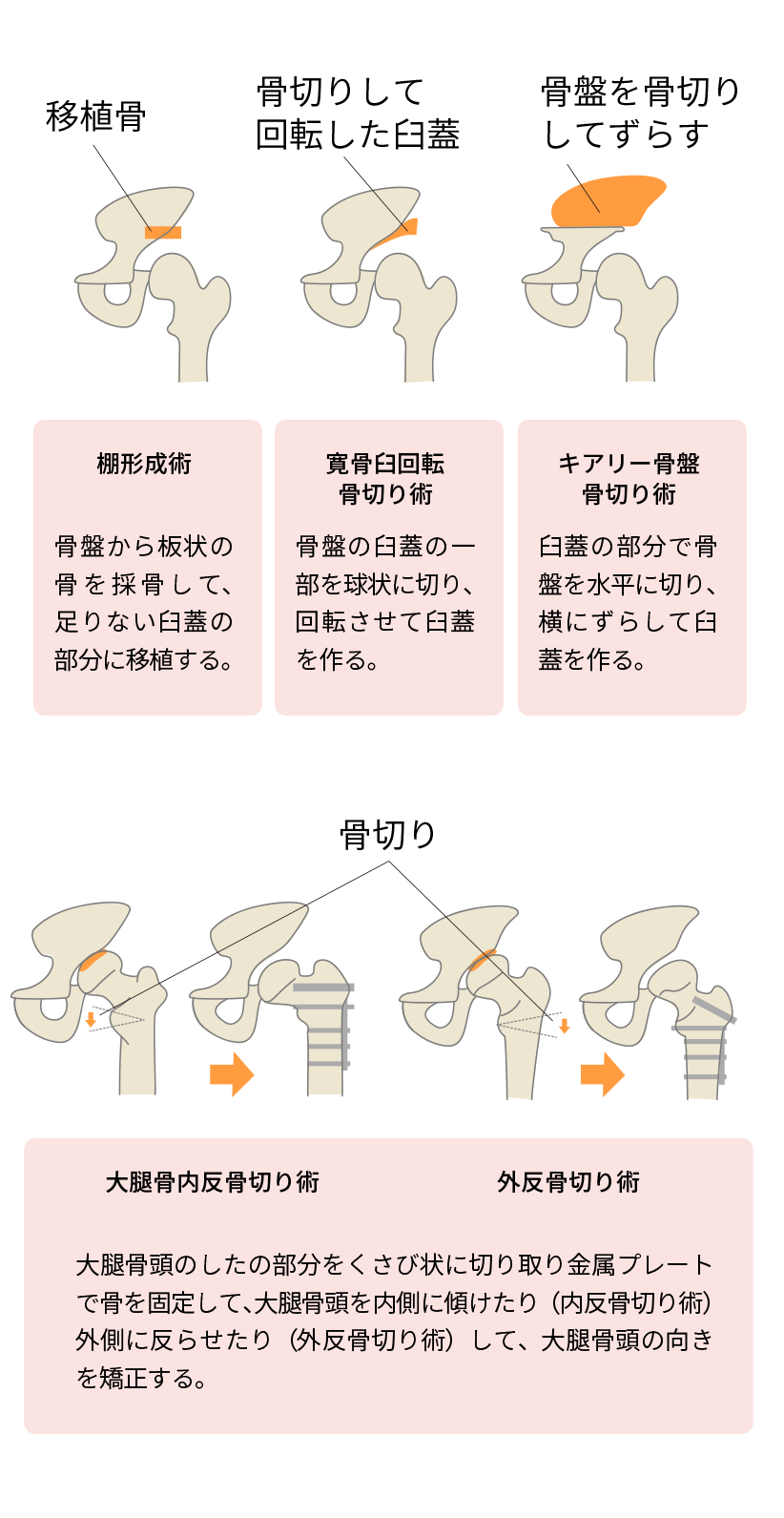 骨切り術