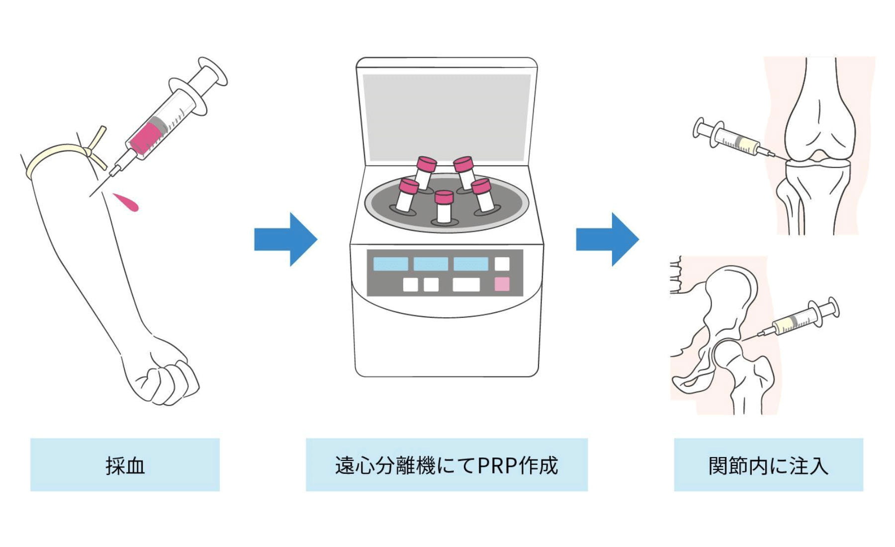 多血小板血漿(PRP)療法