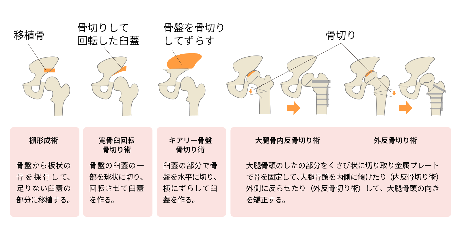 骨切り術