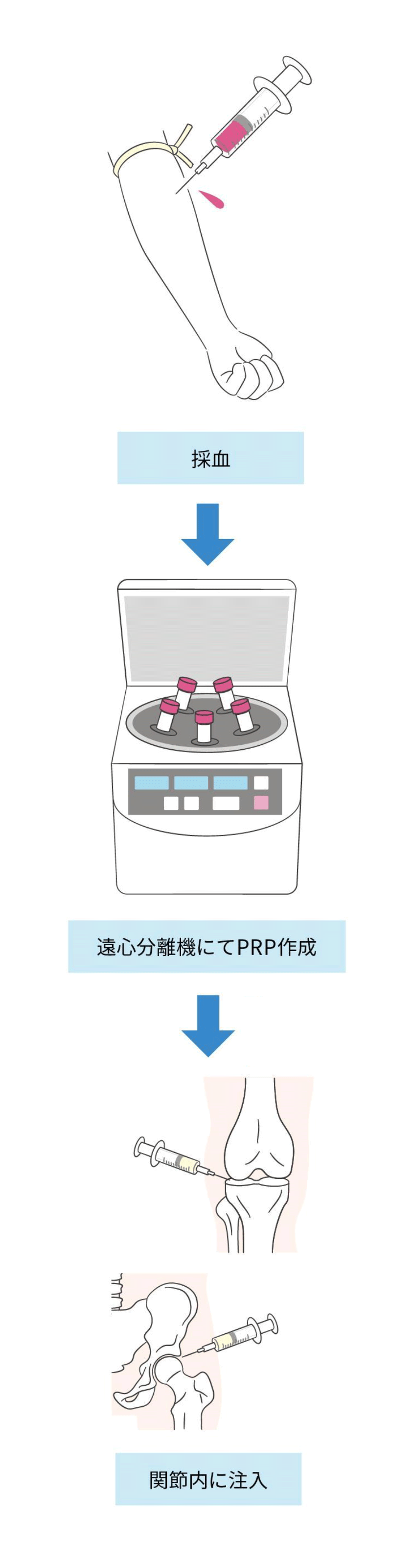 多血小板血漿(PRP)療法