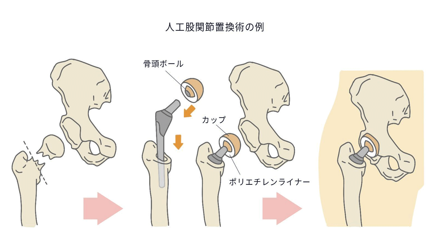 人工股関節置換術の例