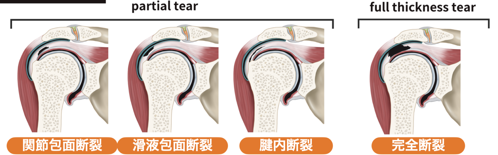 腱板断裂の症状 リハビリ 手術を医師が解説 人工関節と脊椎手術なら横浜町田関節脊椎病院