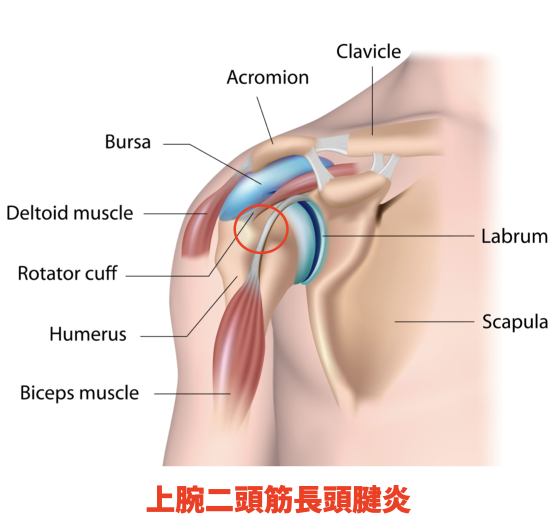 肩 関節 周囲 炎